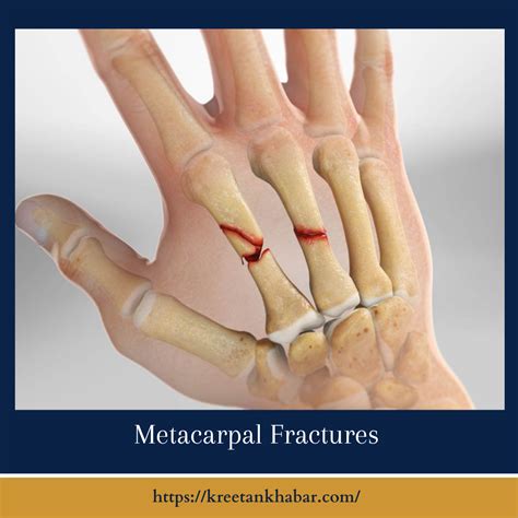 long bone compression test for metacarpal fractures|metacarpal fracture diagnosis.